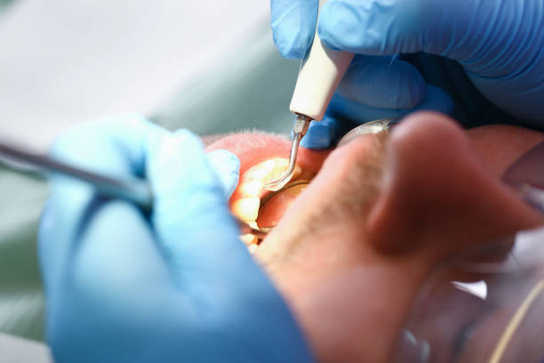 Best Emergency Treatment for Dental Infections or Abscesses in Wilber, NE